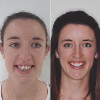 Patient before and after Invisalign treatment 1
