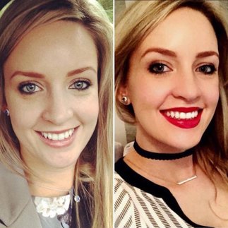 Patient before and after Invisalign treatment 2