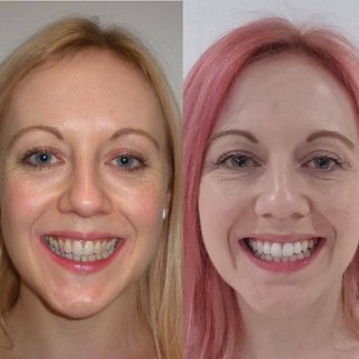 Patient before and after Invisalign treatment 3